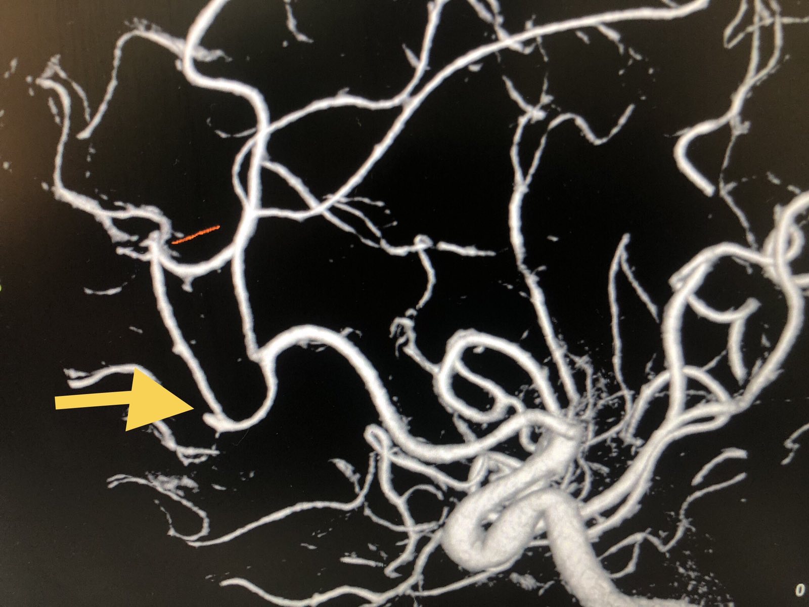 Challenges That May Arise In DACA(Distal Anterior Cerebral Artery ...