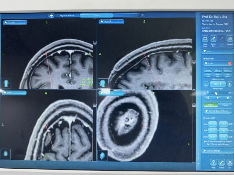 Radiosurgery(रेडियोसर्जरी)
