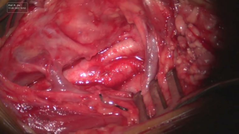 Carotid Endarterectomy (CEA) – Part 8