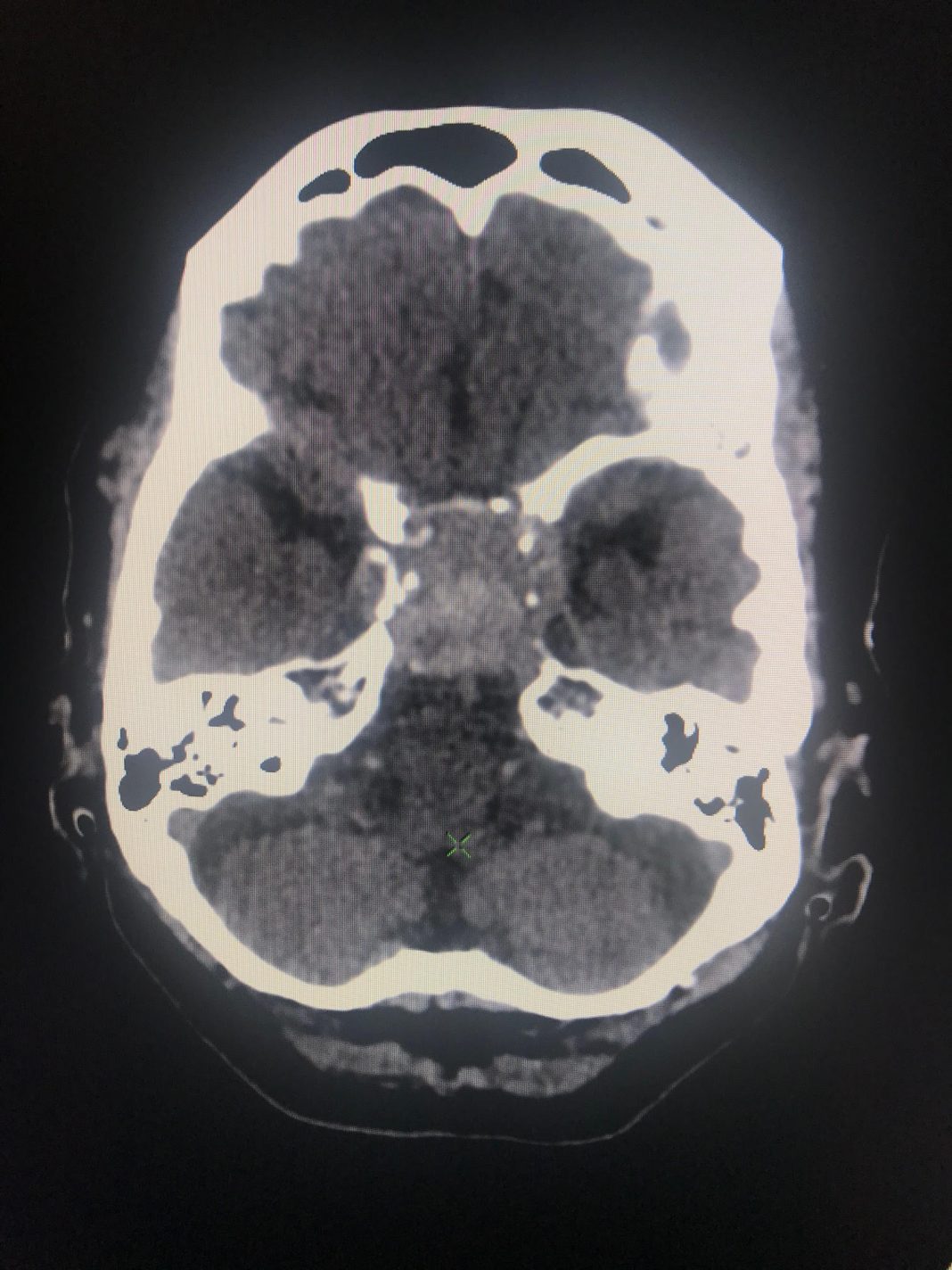 Pituitary apoplexy with aneurysm